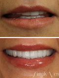 Simply Veneers
