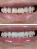 Smile Makeover
